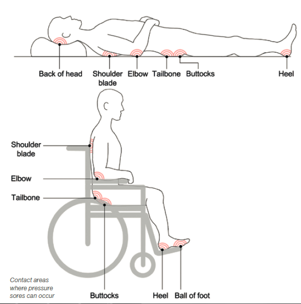 Diagram showing common pressure sore areas for a person lying in bed and sitting in a wheelchair